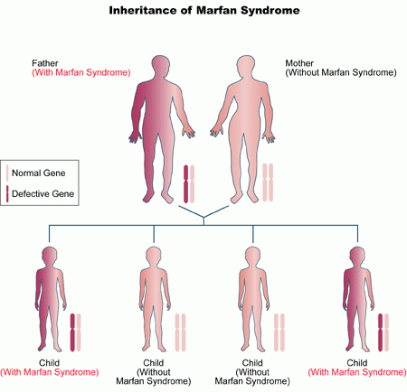 Marfan Syndrome Physiopedia