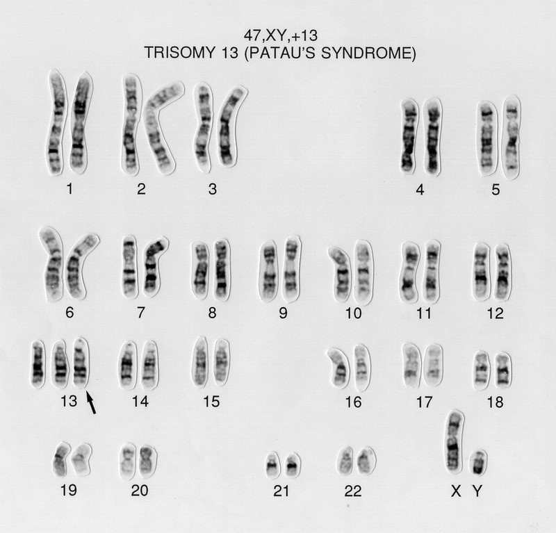 Patau 39 s Syndrome Karyotype 47 XY 13 Wellcome Collection