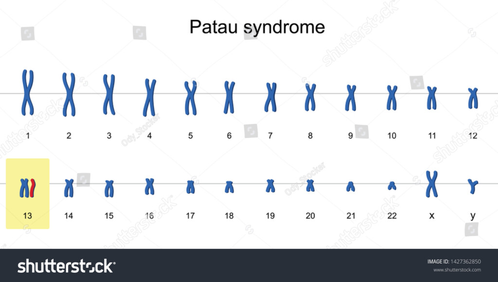 Patau Syndrome Karyotype Autosomal Abnormalities Trisomy Stock Vector 