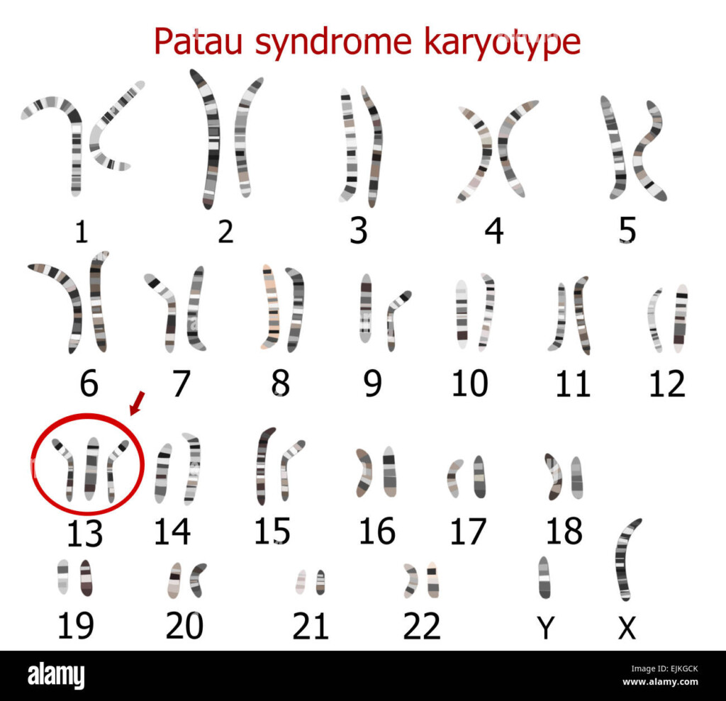 Patau Syndrome Karyotype trisomy 13 Stock Photo Alamy