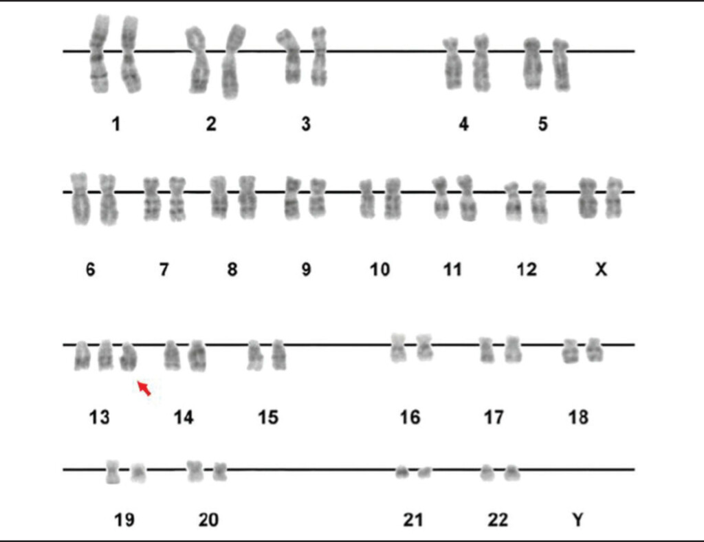 Patau Syndrome Trisomy 13 Concise Medical Knowledge